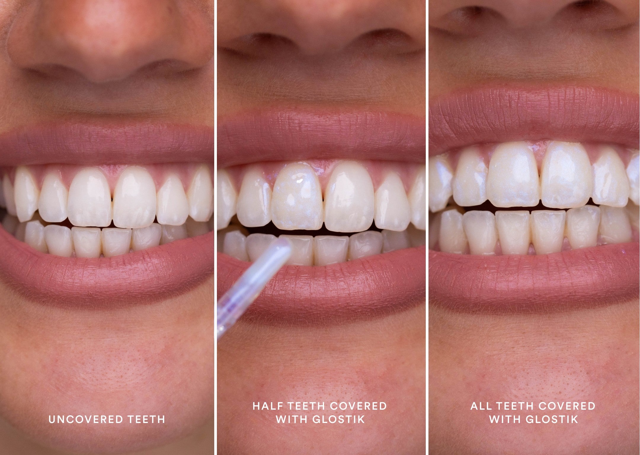 HiSmile Teeth Whitening Review – Our In-depth Guide - Dental Aware